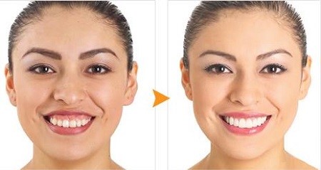 Hình ảnh trước và sau khi phẫu thuật cắt nước